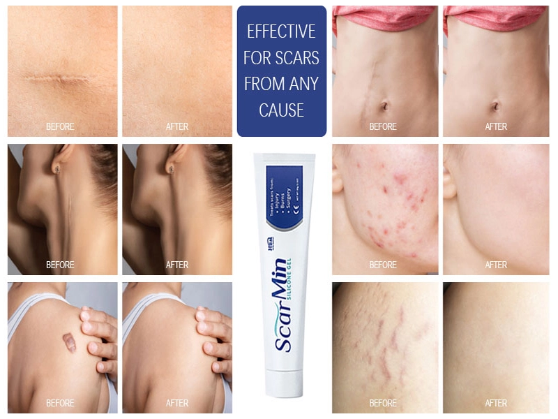 The Importance of Scar Gel